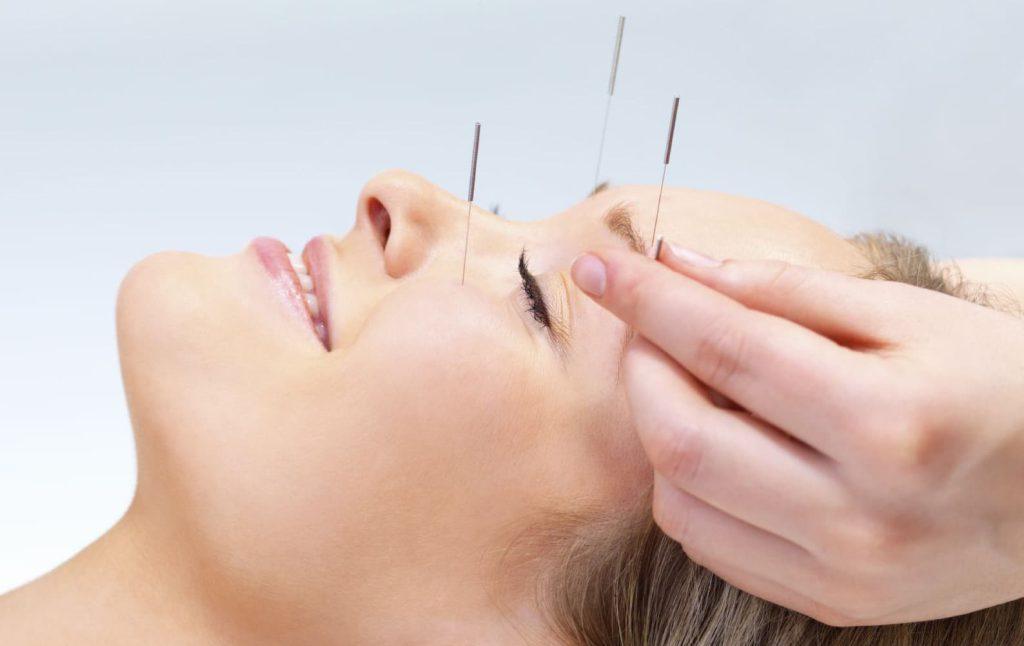 طب سوزنی سردرد طب سوزنی