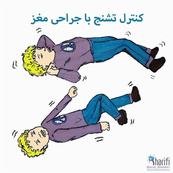تشنج و جراحی به وسیله متخصص تشنج کودک و بزرگسال