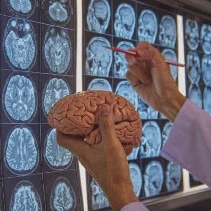 تومور مغزی + معرفی بهترین متخصص مغز و اعصاب 2023