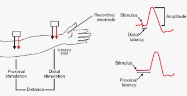 الکترومیوگرافی EMG و NCV مطالعات هدایت عصبی