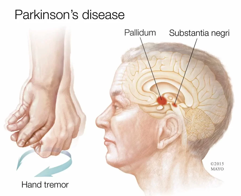 علت بیماری پارکینسون (PD)