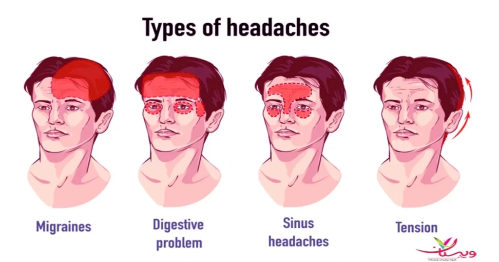 انواع سردردهای رایج، از علل تا تشخیص و درمان-https://www.drrafizadeh.ir