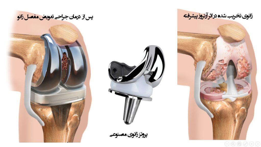 جایگزینی مفصل زانو قبل و بعد از عمل زانو