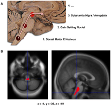  نموداری از پیشروی اولیه جسم لویی در اولین مراحل پارکینسون که توسط براک و همکاران پیشنهاد شده‌است. B – مکان‌یابی کاهش حجم در بیمار مبتلا به مراحل اولیه پارکینسون در مقایسه با گروهی از شرکت‌کنندگان غیرمبتلا به پارکینسون. در این تحقیق نتیجه‌گیری شد که آسیب ساقه مغز ممکن است اولین مرحله قابل‌شناسایی در آسیب‌شناسی عصبی پارکینسون باشد