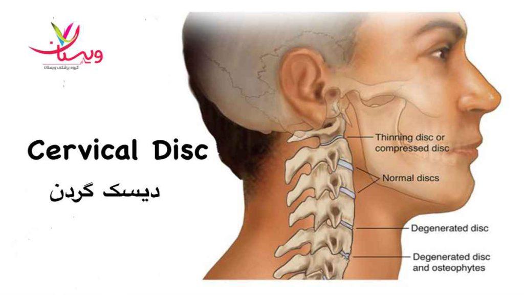 روش های درمان دیسک گردن