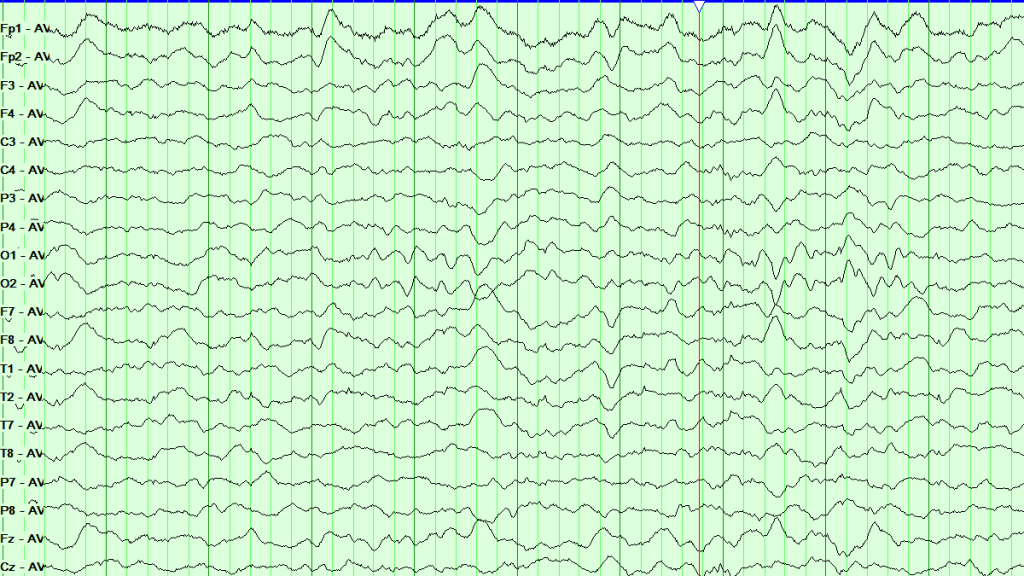linear EEG