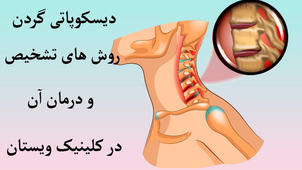 یک اسکلت گردن که در آن دیسکوپاتی گردن نشان داده شده است