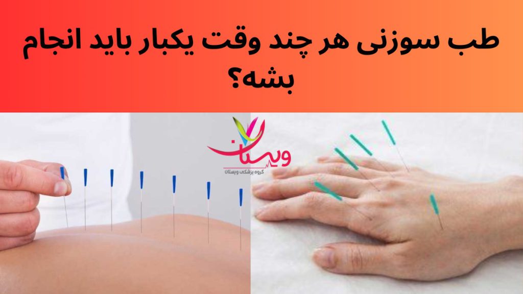 فاصله بین جلسات طب سوزنی طب سوزنی هر چند وقت یکبار باید انجام بشه