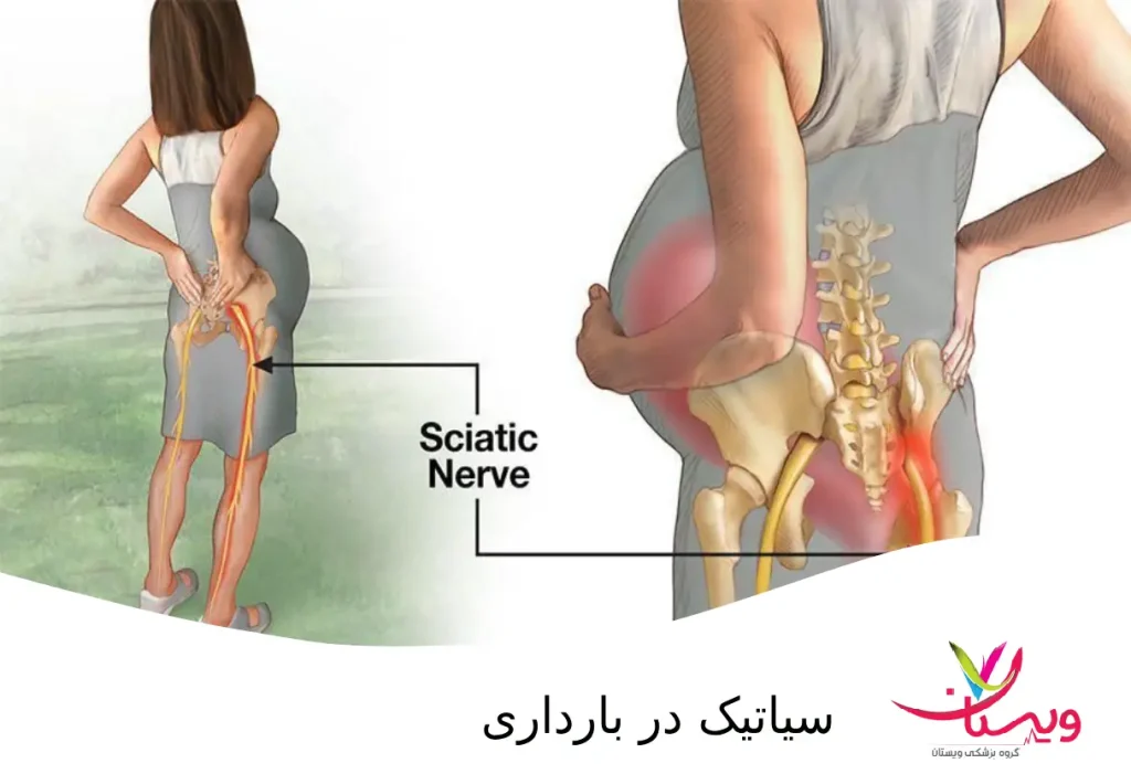نمای اسکلت یک زن باردار و فشار سیاتیک
