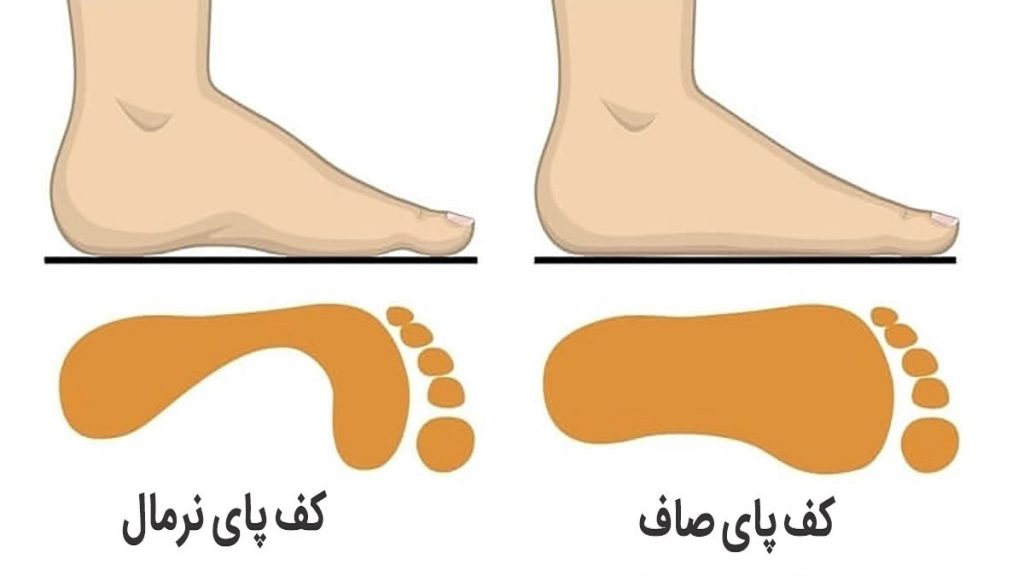 علل و علائم صافی کف پا
