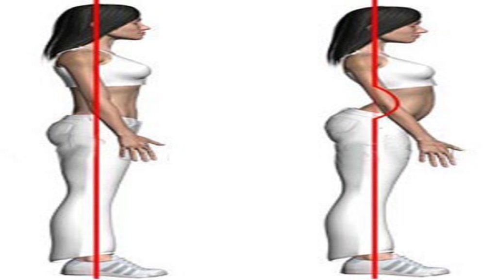 درمان سریع گودی کمر در زنان + 6 حرکات اصلاحی برای درمان